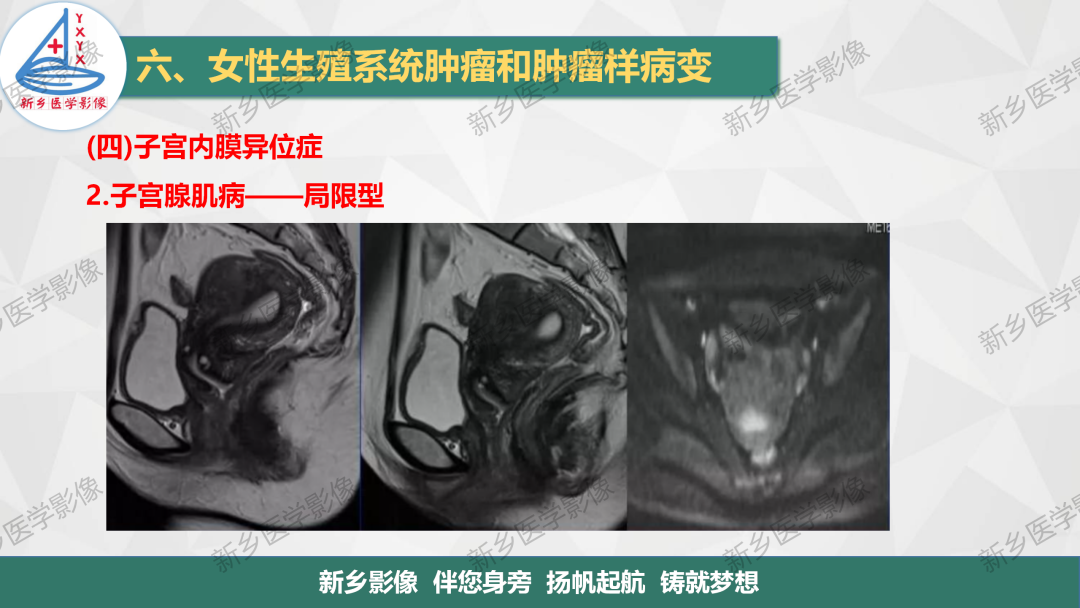 影像PPT - 【PPT】宫颈癌及子宫内膜异位症的影像表现-8