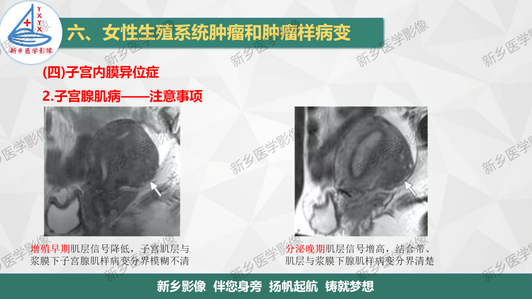 影像PPT - 【PPT】宫颈癌及子宫内膜异位症的影像表现-11