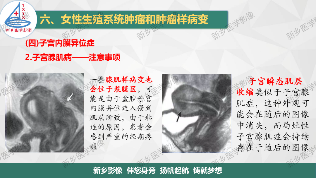 影像PPT - 【PPT】宫颈癌及子宫内膜异位症的影像表现-12