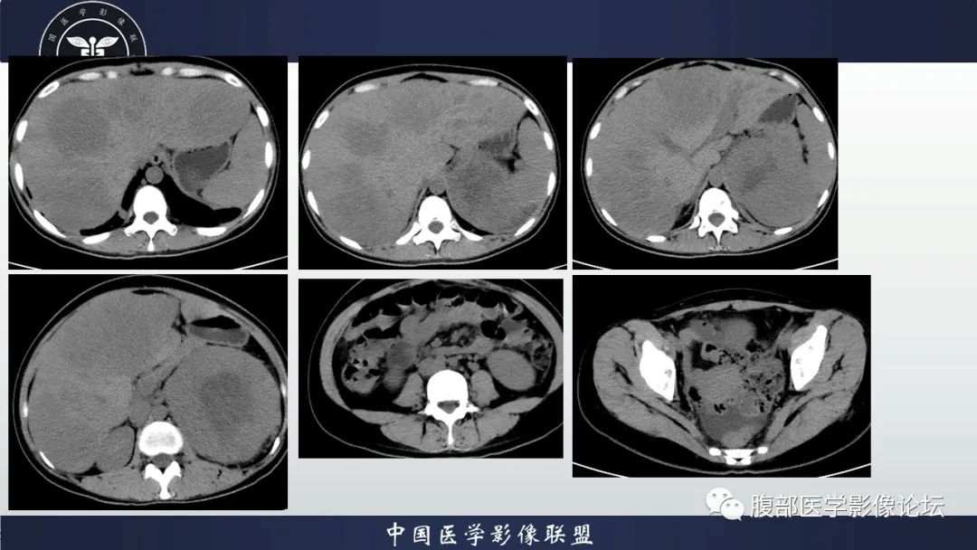 影像PPT - 【病例】促结缔组织增生性小圆细胞肿瘤DSRCT一例影像诊断-3