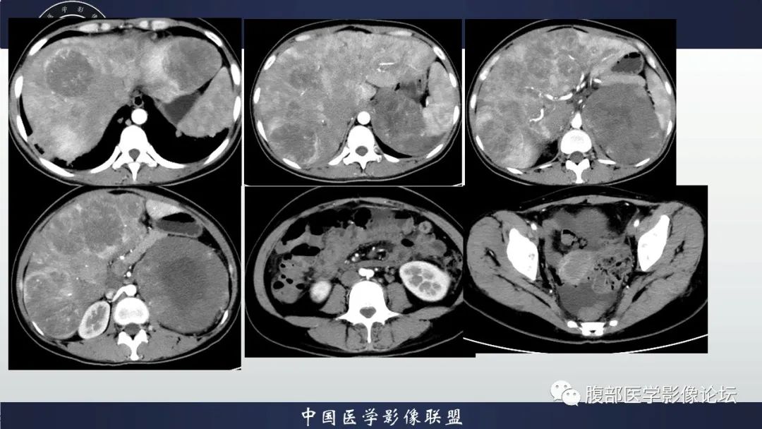 影像PPT - 【病例】促结缔组织增生性小圆细胞肿瘤DSRCT一例影像诊断-4