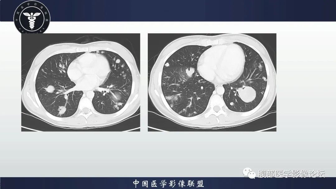 影像PPT - 【病例】促结缔组织增生性小圆细胞肿瘤DSRCT一例影像诊断-6