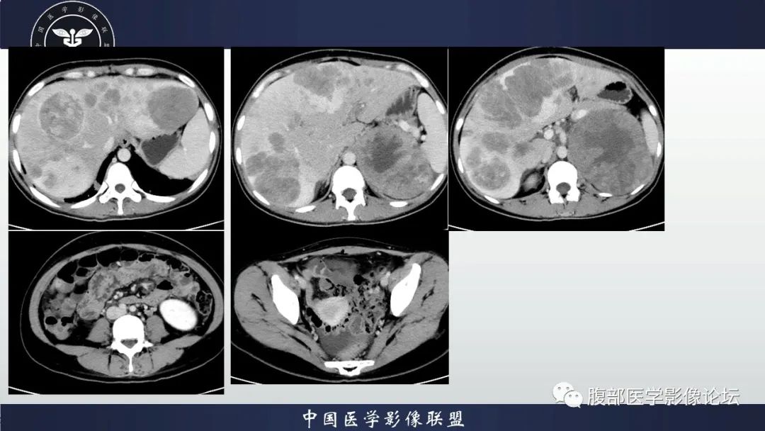 影像PPT - 【病例】促结缔组织增生性小圆细胞肿瘤DSRCT一例影像诊断-5