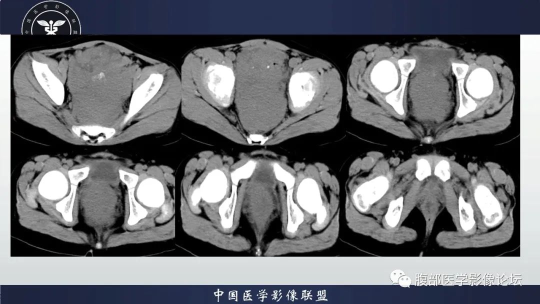 影像PPT - 【病例】促结缔组织增生性小圆细胞肿瘤DSRCT一例影像诊断-10