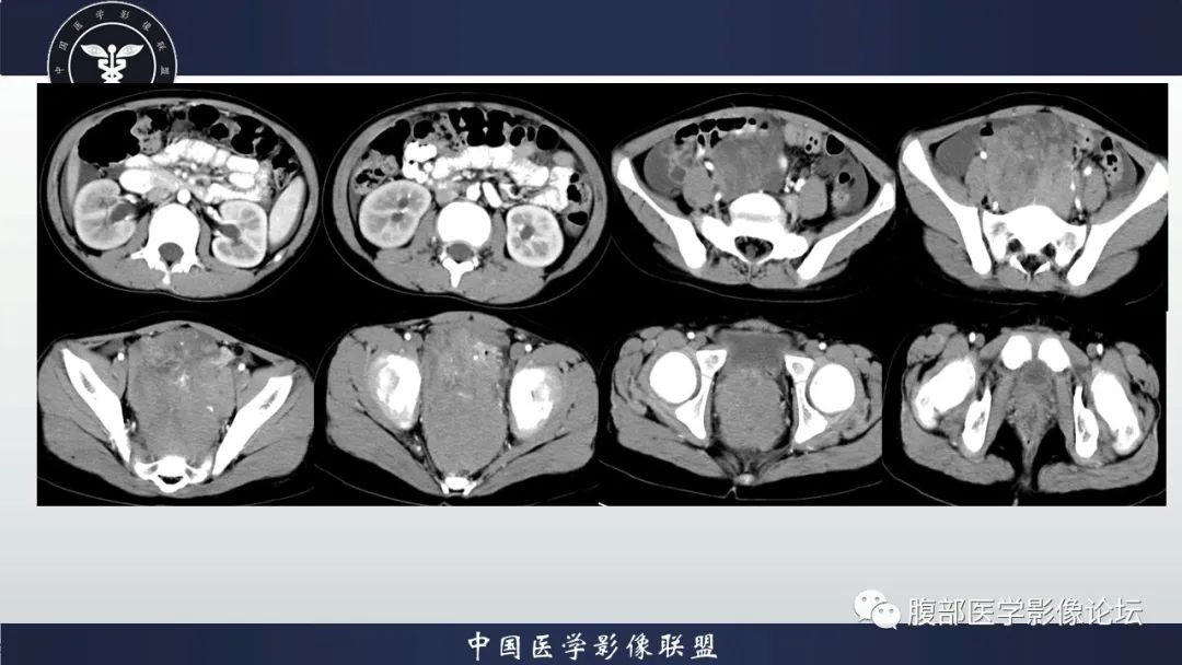 影像PPT - 【病例】促结缔组织增生性小圆细胞肿瘤DSRCT一例影像诊断-11