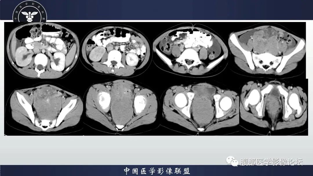 影像PPT - 【病例】促结缔组织增生性小圆细胞肿瘤DSRCT一例影像诊断-12