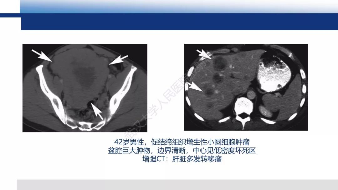 影像PPT - 【病例】促结缔组织增生性小圆细胞肿瘤DSRCT一例影像诊断-20
