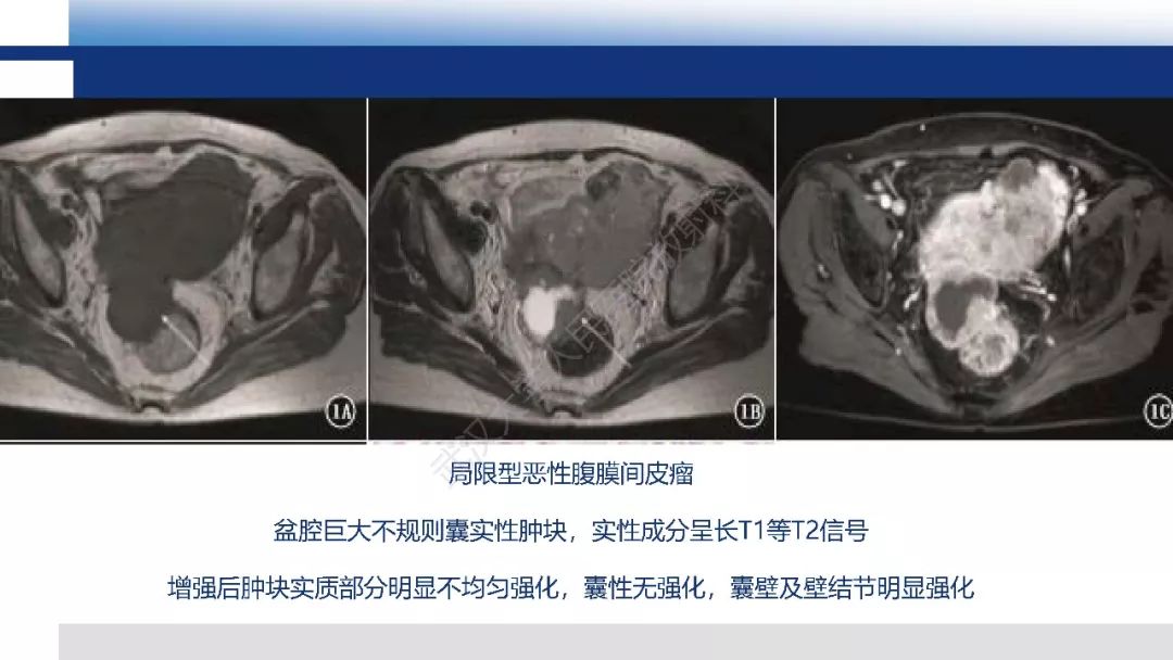 影像PPT - 【病例】促结缔组织增生性小圆细胞肿瘤DSRCT一例影像诊断-25