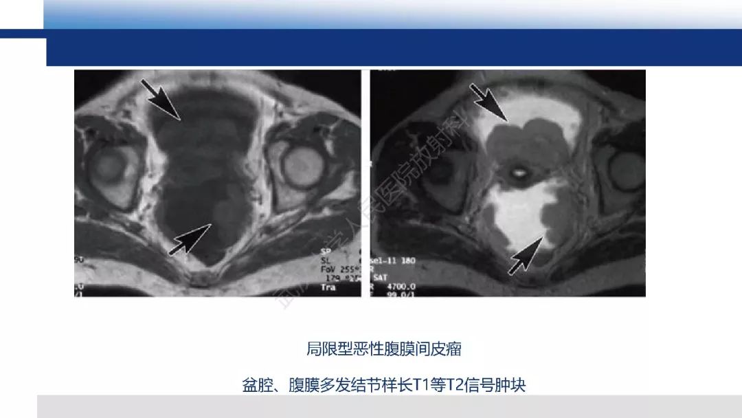 影像PPT - 【病例】促结缔组织增生性小圆细胞肿瘤DSRCT一例影像诊断-26
