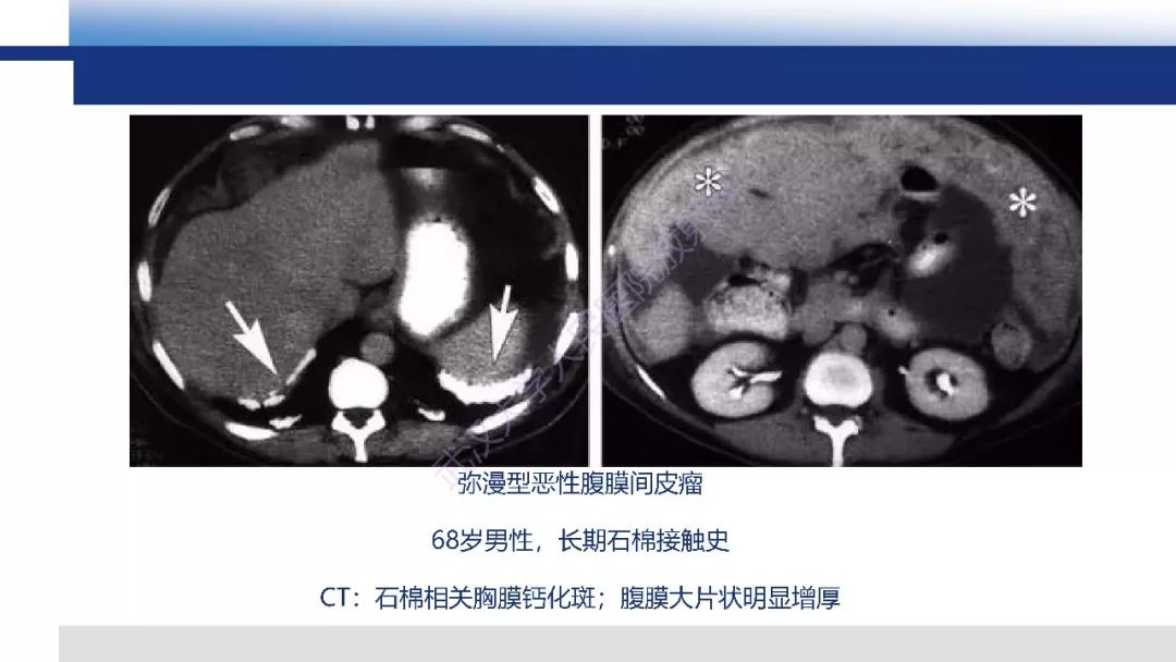 影像PPT - 【病例】促结缔组织增生性小圆细胞肿瘤DSRCT一例影像诊断-27