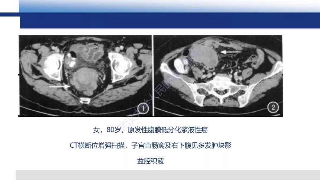 影像PPT - 【病例】促结缔组织增生性小圆细胞肿瘤DSRCT一例影像诊断-29