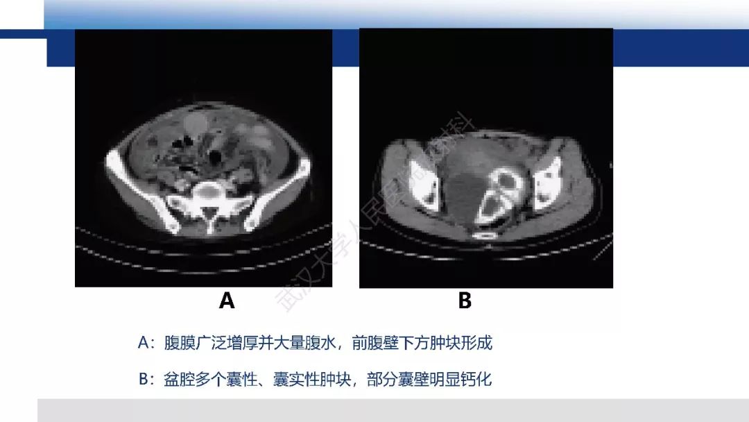 影像PPT - 【病例】促结缔组织增生性小圆细胞肿瘤DSRCT一例影像诊断-30