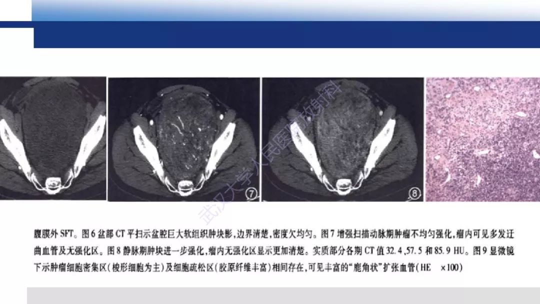 影像PPT - 【病例】促结缔组织增生性小圆细胞肿瘤DSRCT一例影像诊断-35