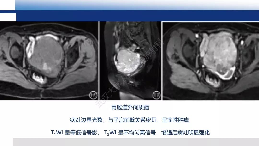 影像PPT - 【病例】促结缔组织增生性小圆细胞肿瘤DSRCT一例影像诊断-37