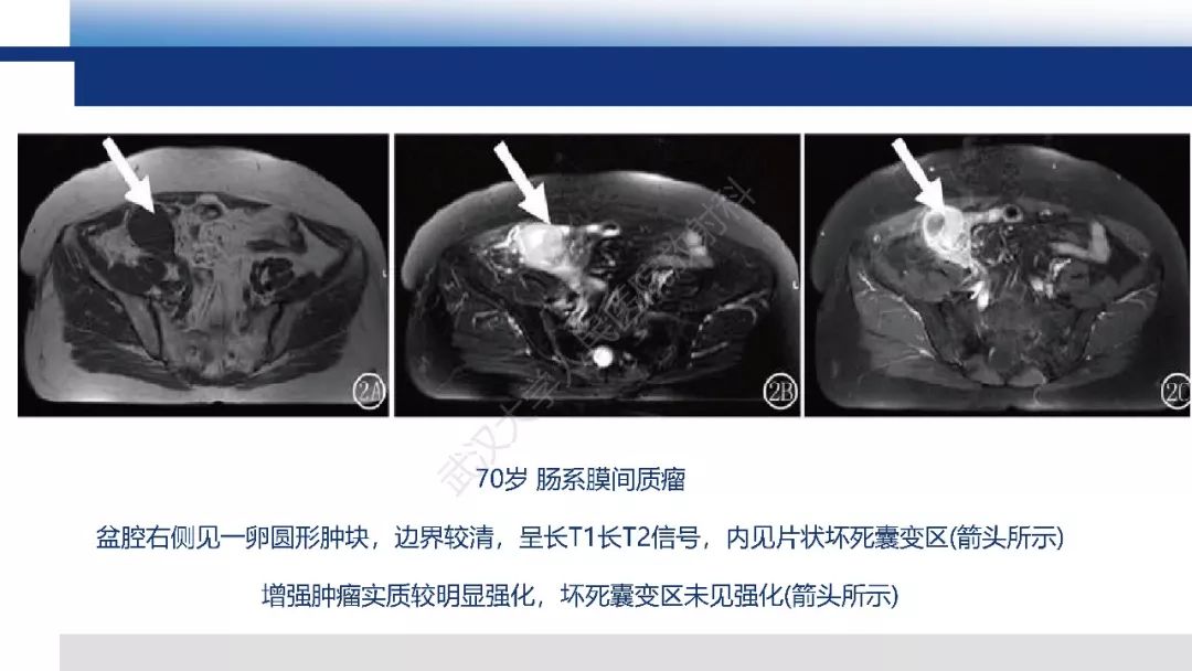 影像PPT - 【病例】促结缔组织增生性小圆细胞肿瘤DSRCT一例影像诊断-38
