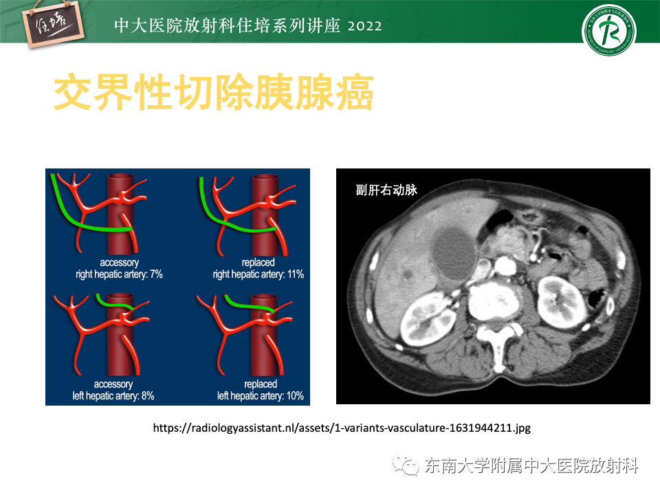 影像PPT - 【PPT】胰腺癌MDCT可切除性评估-15
