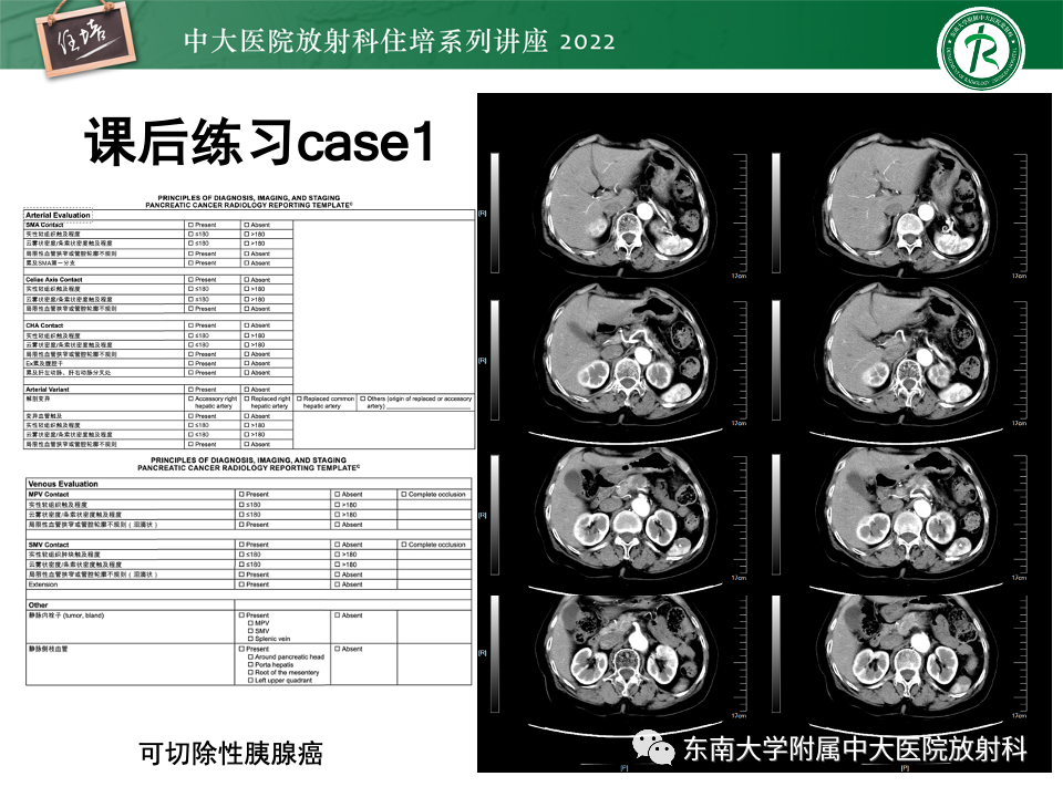 影像PPT - 【PPT】胰腺癌MDCT可切除性评估-20