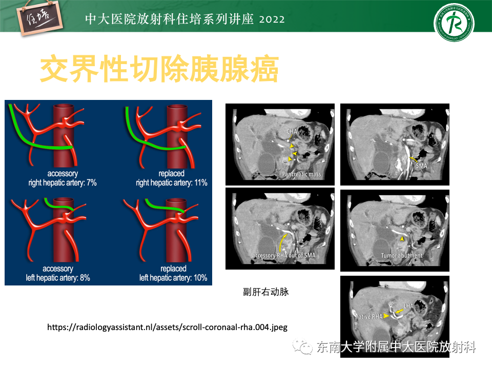 影像PPT - 【PPT】胰腺癌MDCT可切除性评估-16