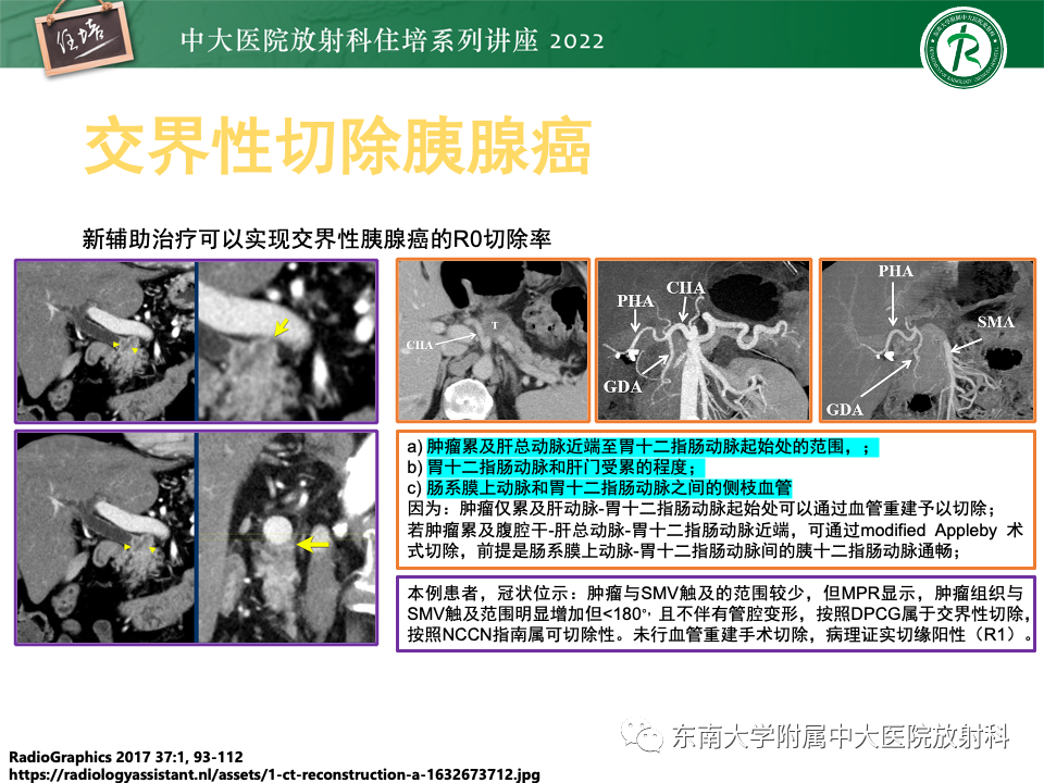 影像PPT - 【PPT】胰腺癌MDCT可切除性评估-14