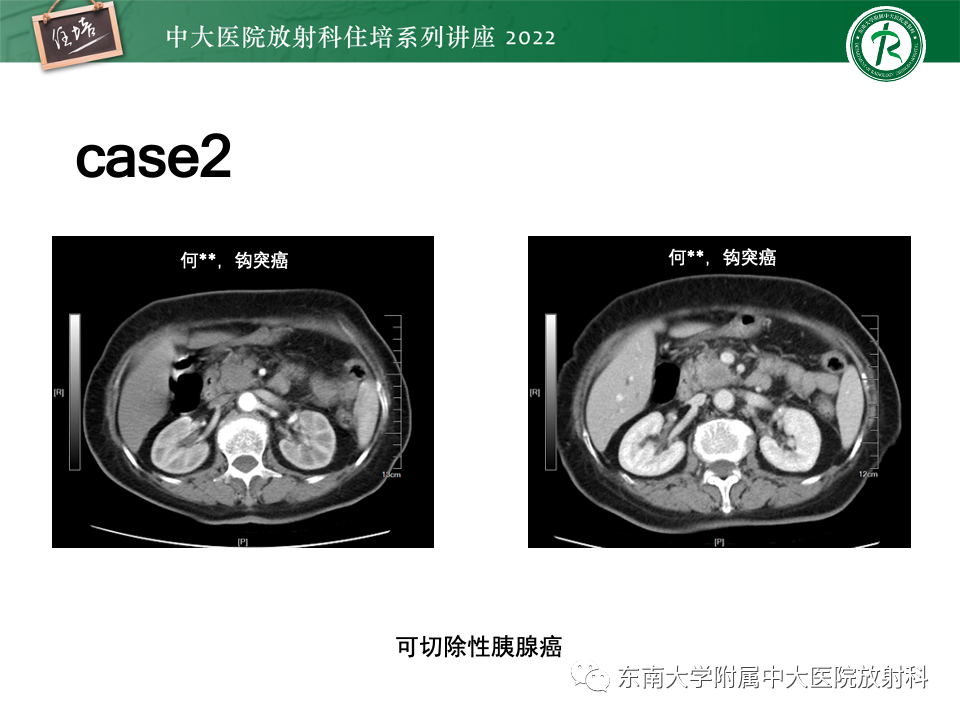 影像PPT - 【PPT】胰腺癌MDCT可切除性评估-22
