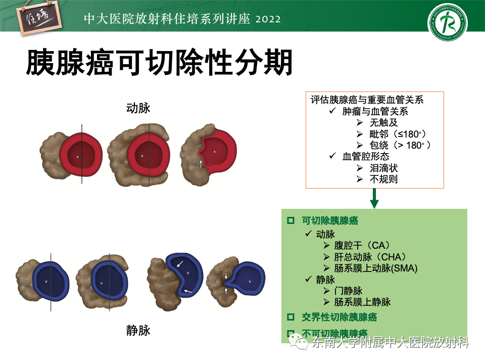 影像PPT - 【PPT】胰腺癌MDCT可切除性评估-9