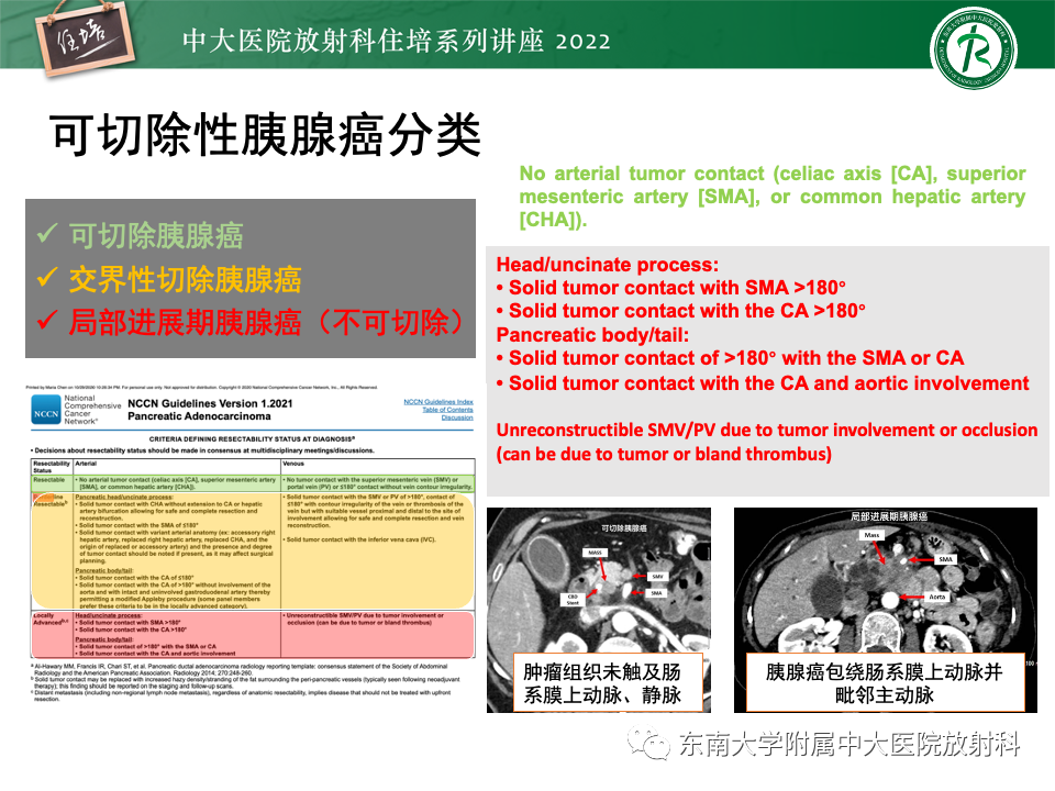 影像PPT - 【PPT】胰腺癌MDCT可切除性评估-11