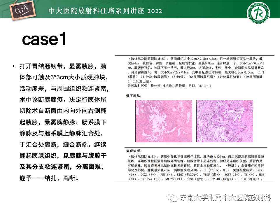 影像PPT - 【PPT】胰腺癌MDCT可切除性评估-21