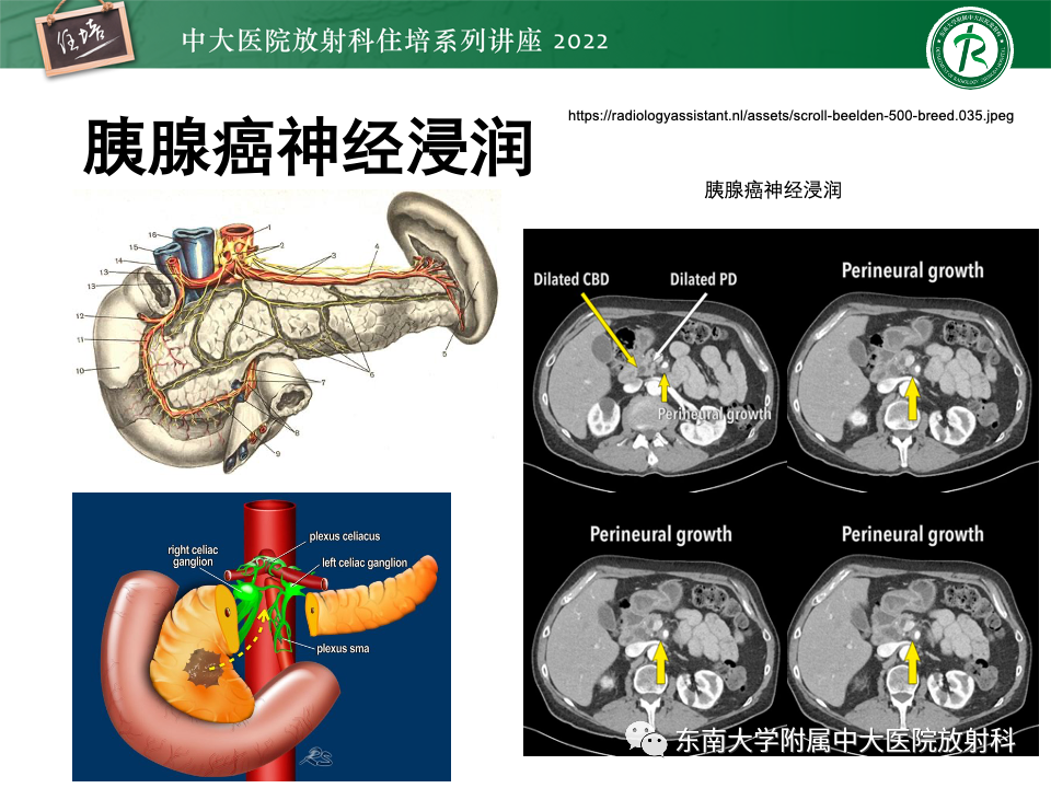影像PPT - 【PPT】胰腺癌MDCT可切除性评估-17