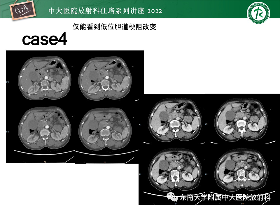 影像PPT - 【PPT】胰腺癌MDCT可切除性评估-28