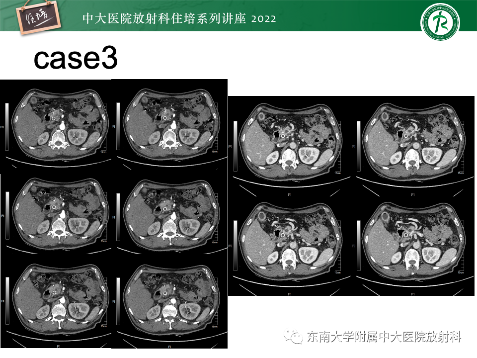 影像PPT - 【PPT】胰腺癌MDCT可切除性评估-25