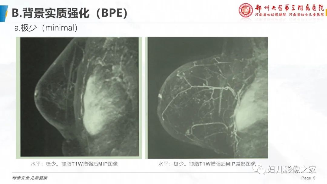 影像PPT - 【PPT】乳腺MRI诊断规范-5