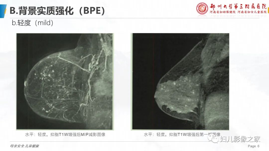 影像PPT - 【PPT】乳腺MRI诊断规范-6