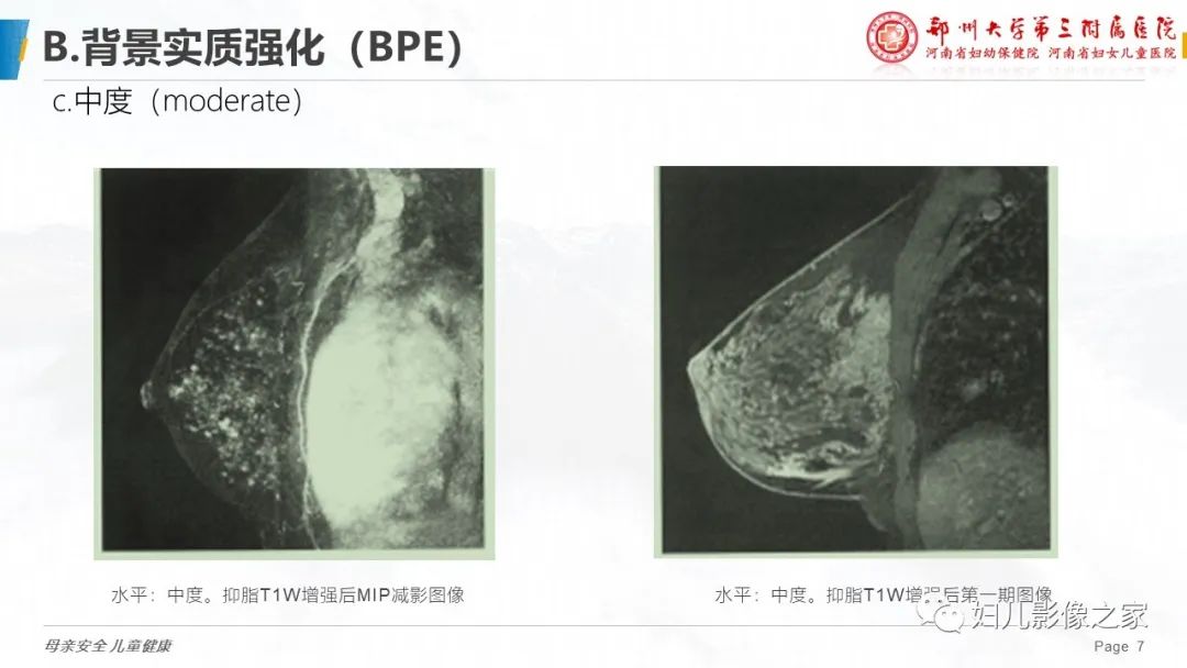 影像PPT - 【PPT】乳腺MRI诊断规范-7