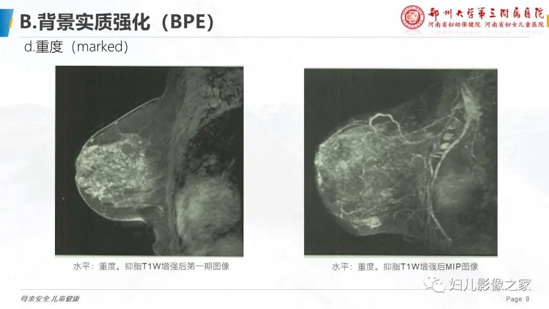 影像PPT - 【PPT】乳腺MRI诊断规范-8