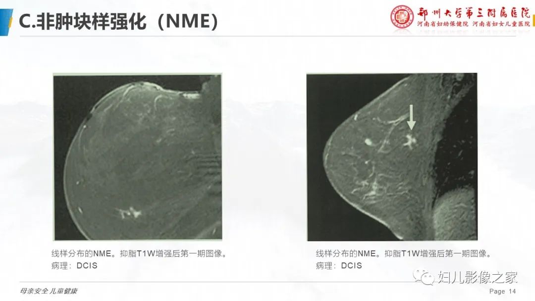 影像PPT - 【PPT】乳腺MRI诊断规范-14