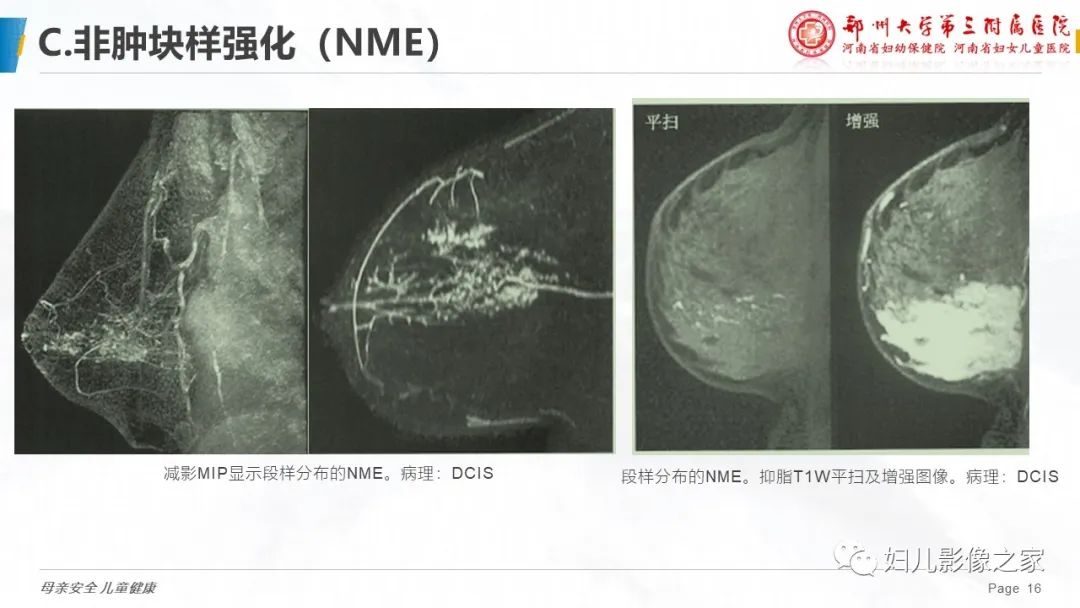 影像PPT - 【PPT】乳腺MRI诊断规范-16