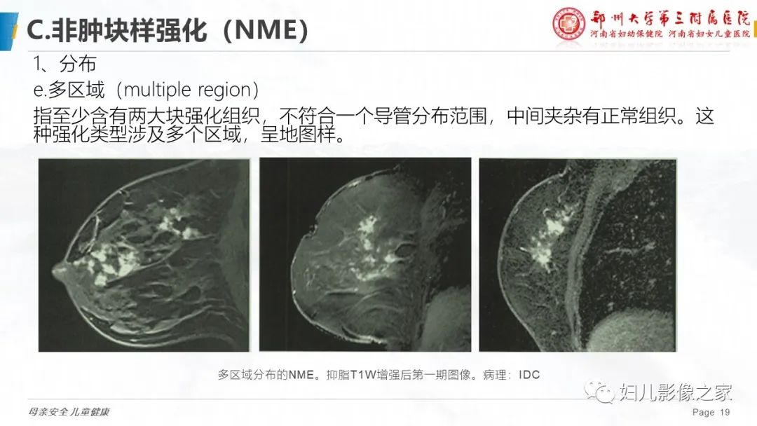 影像PPT - 【PPT】乳腺MRI诊断规范-19