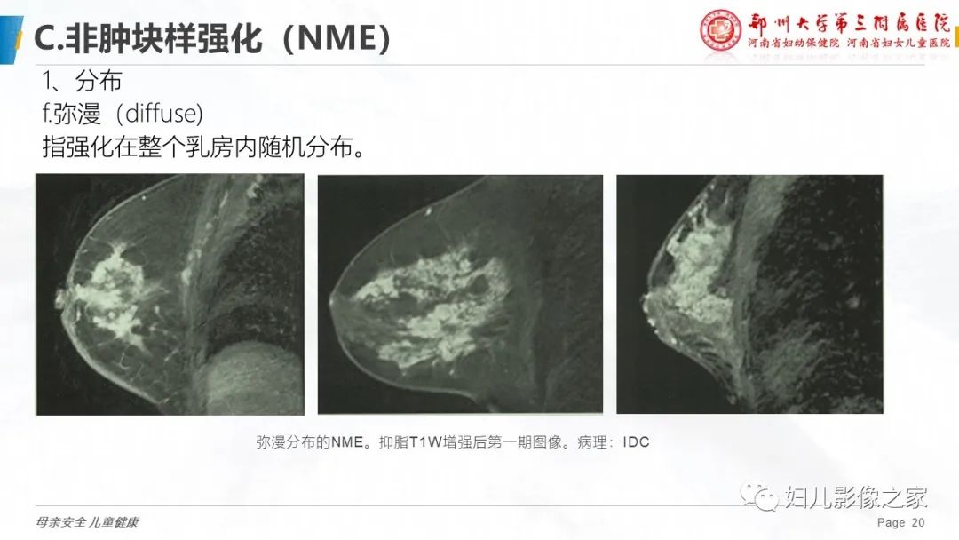 影像PPT - 【PPT】乳腺MRI诊断规范-20