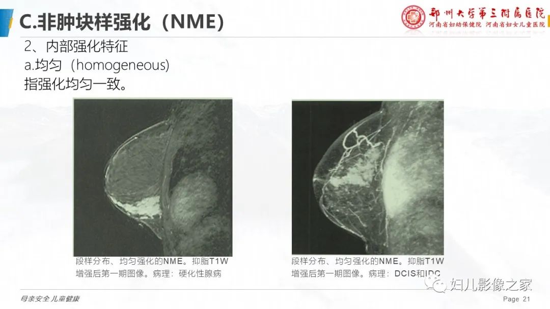 影像PPT - 【PPT】乳腺MRI诊断规范-21