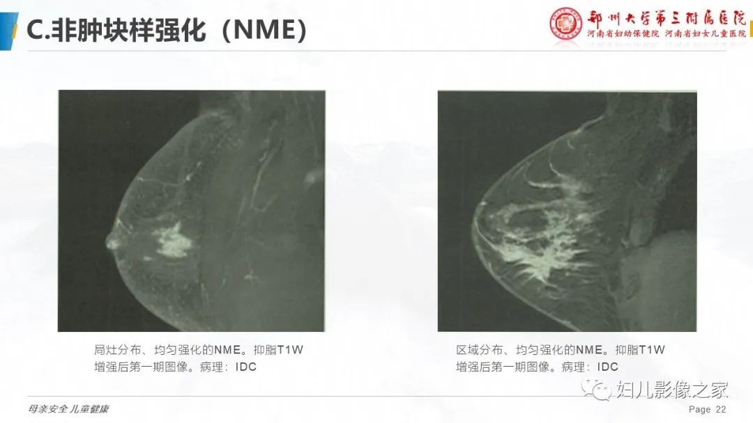 影像PPT - 【PPT】乳腺MRI诊断规范-22