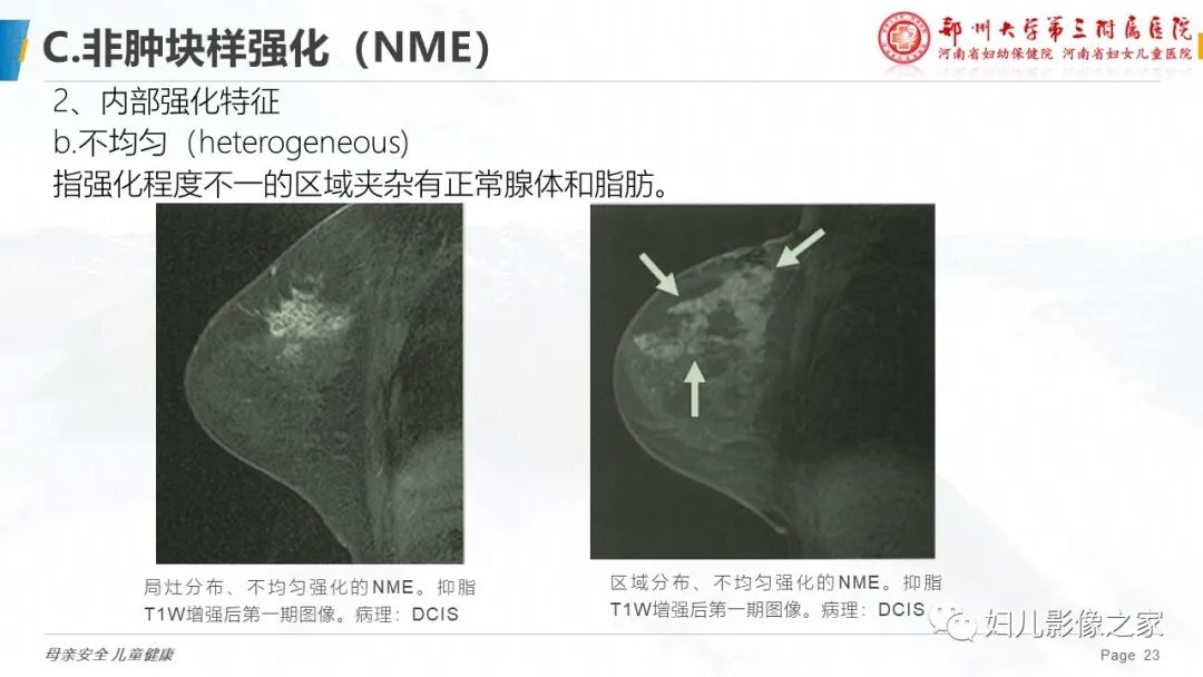 影像PPT - 【PPT】乳腺MRI诊断规范-23