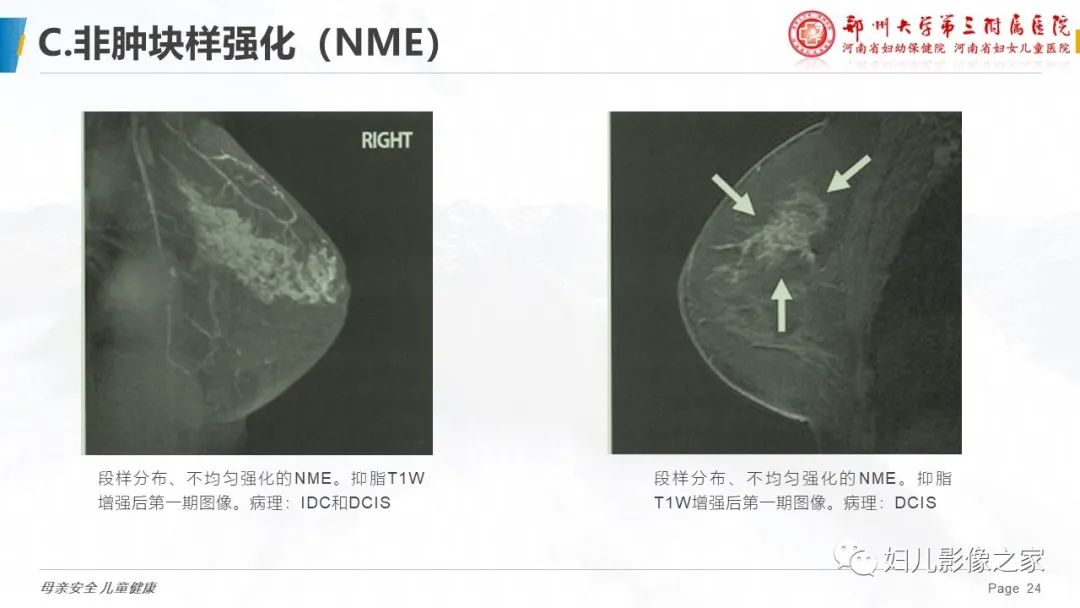 影像PPT - 【PPT】乳腺MRI诊断规范-24