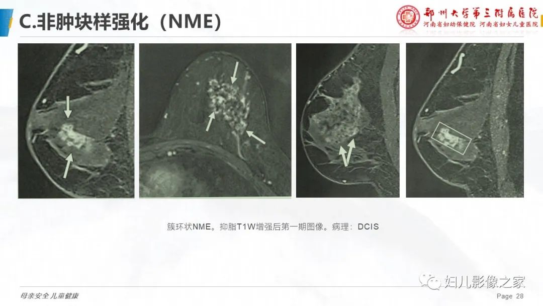 影像PPT - 【PPT】乳腺MRI诊断规范-28