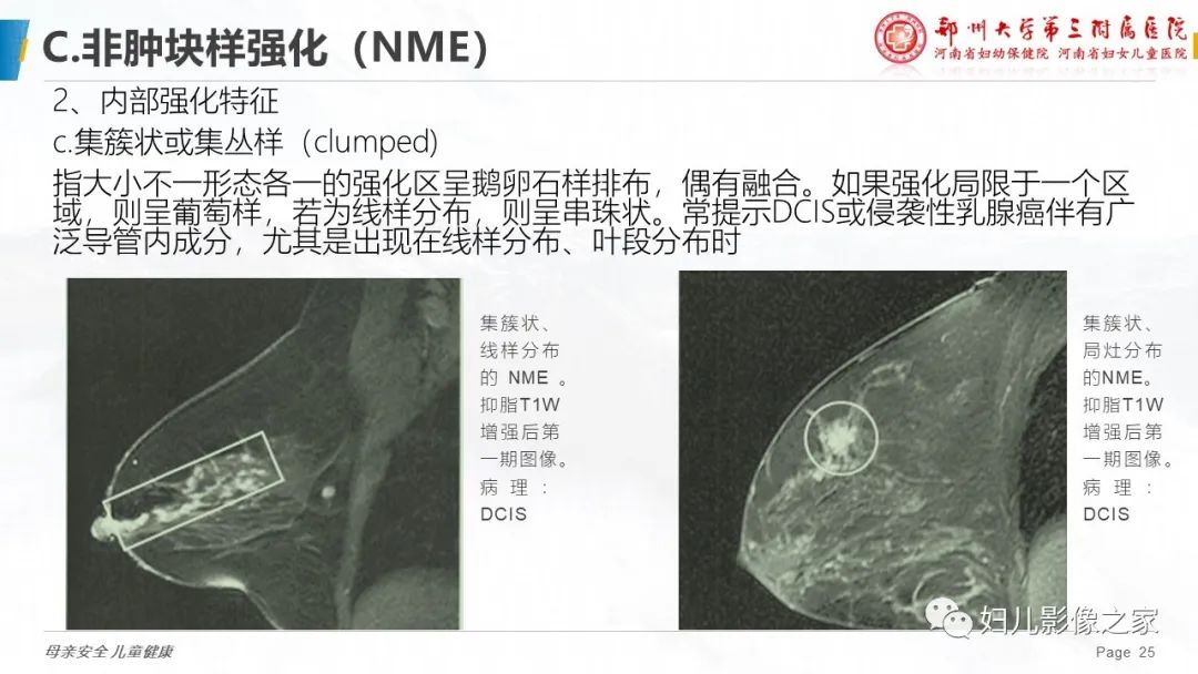 影像PPT - 【PPT】乳腺MRI诊断规范-25