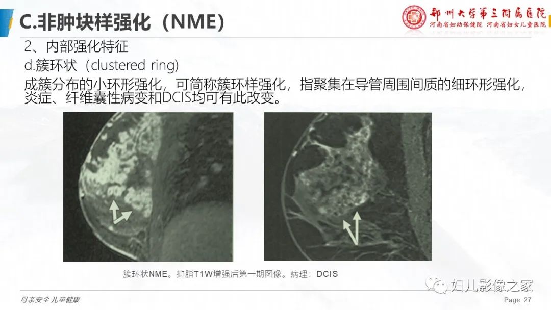 影像PPT - 【PPT】乳腺MRI诊断规范-27