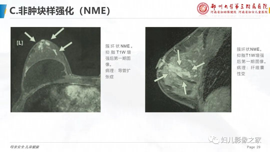 影像PPT - 【PPT】乳腺MRI诊断规范-29