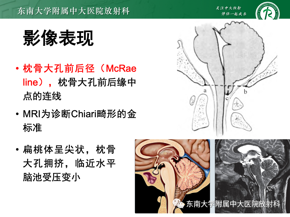 影像PPT - 【PPT】小脑扁桃体下疝畸形-10 影像PPT - 【PPT】小脑扁桃体下疝畸形-10