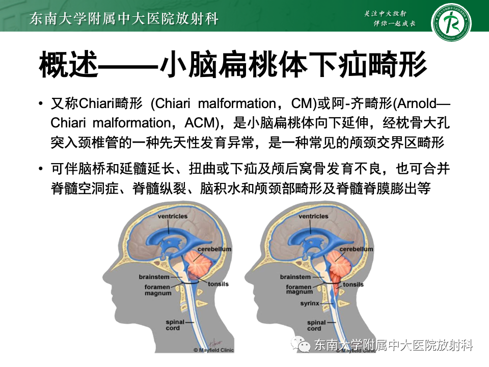 影像PPT - 【PPT】小脑扁桃体下疝畸形-5 影像PPT - 【PPT】小脑扁桃体下疝畸形-5