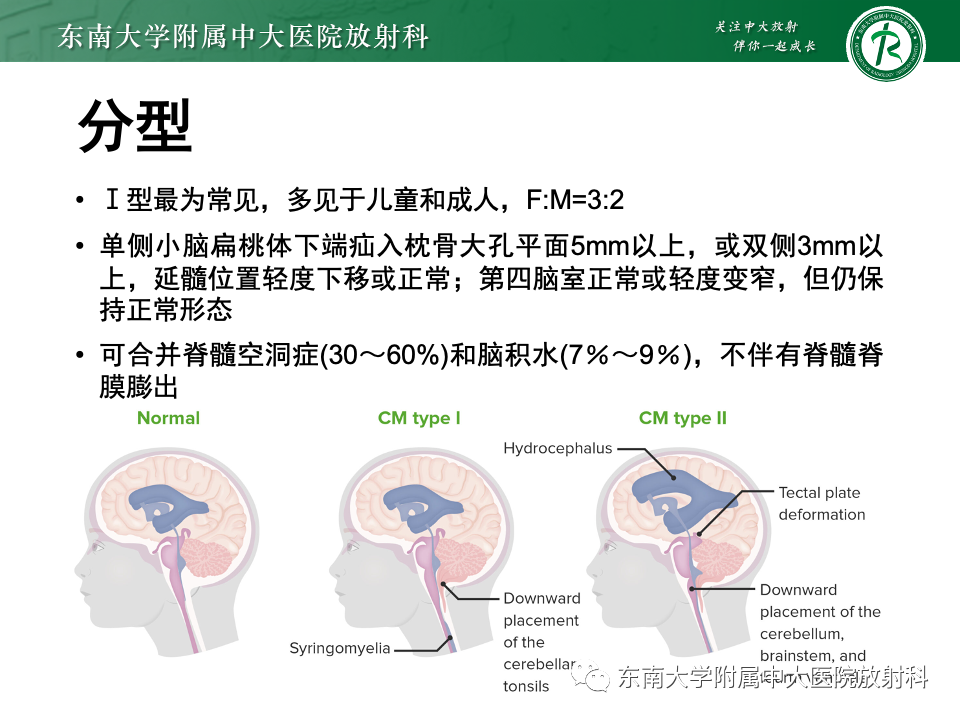 影像PPT - 【PPT】小脑扁桃体下疝畸形-7 影像PPT - 【PPT】小脑扁桃体下疝畸形-7
