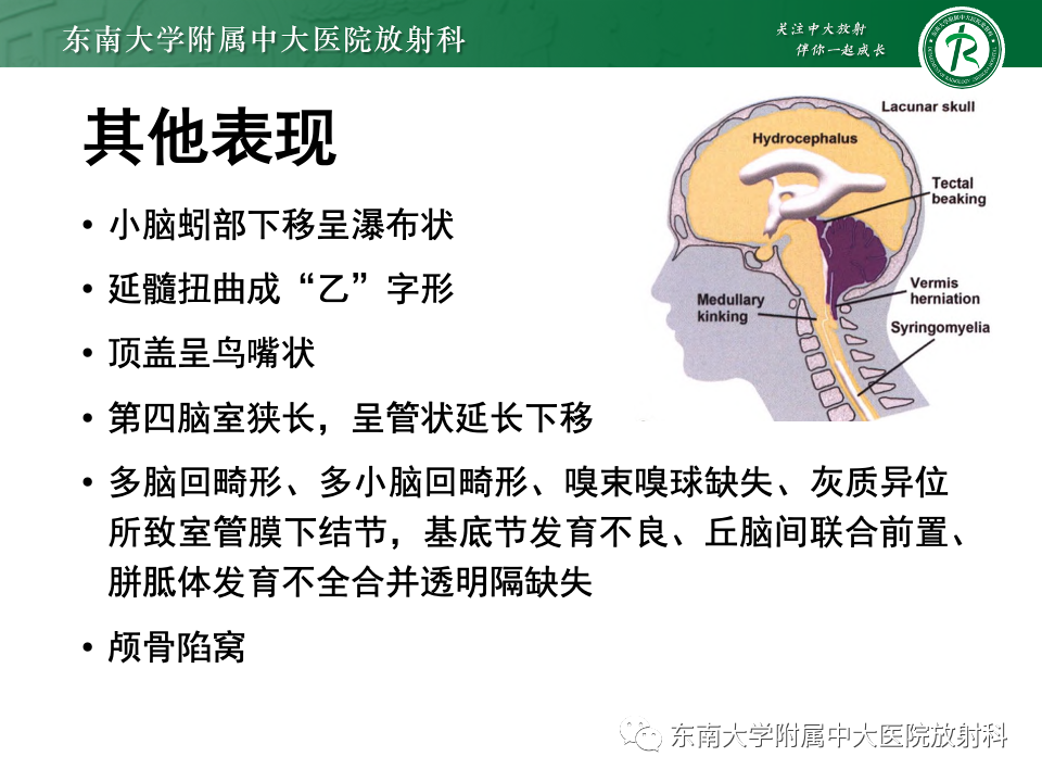 影像PPT - 【PPT】小脑扁桃体下疝畸形-13 影像PPT - 【PPT】小脑扁桃体下疝畸形-13